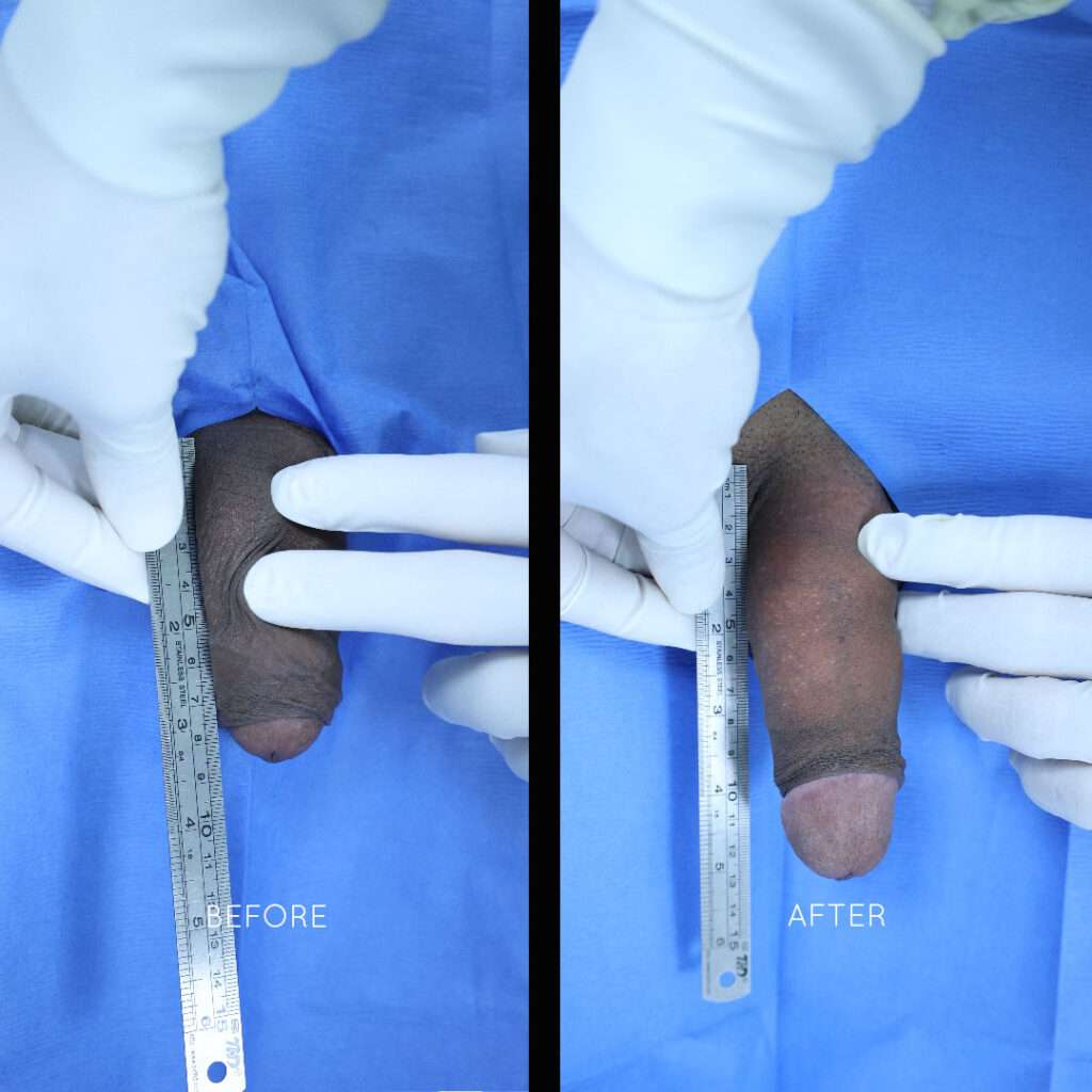 Penile Enhancement Case 1