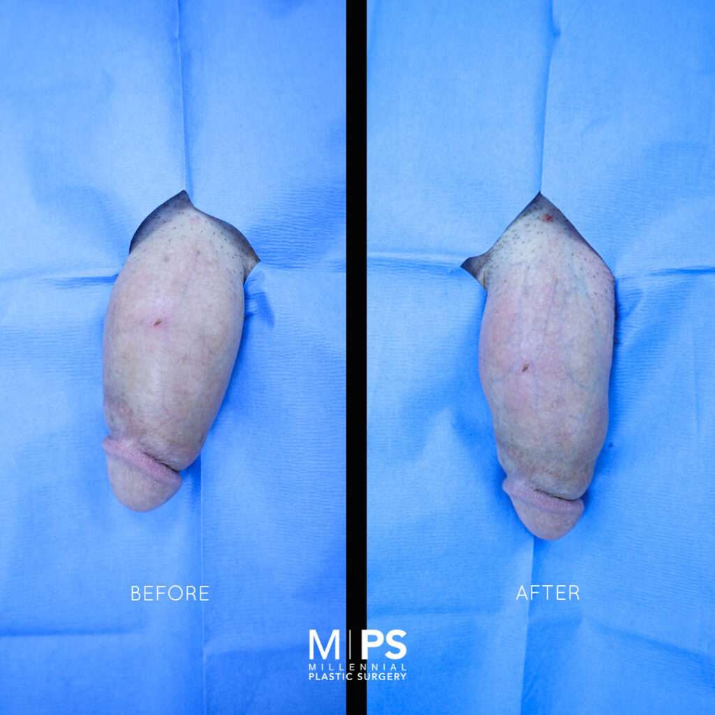 Penile Enhancement Case 10
