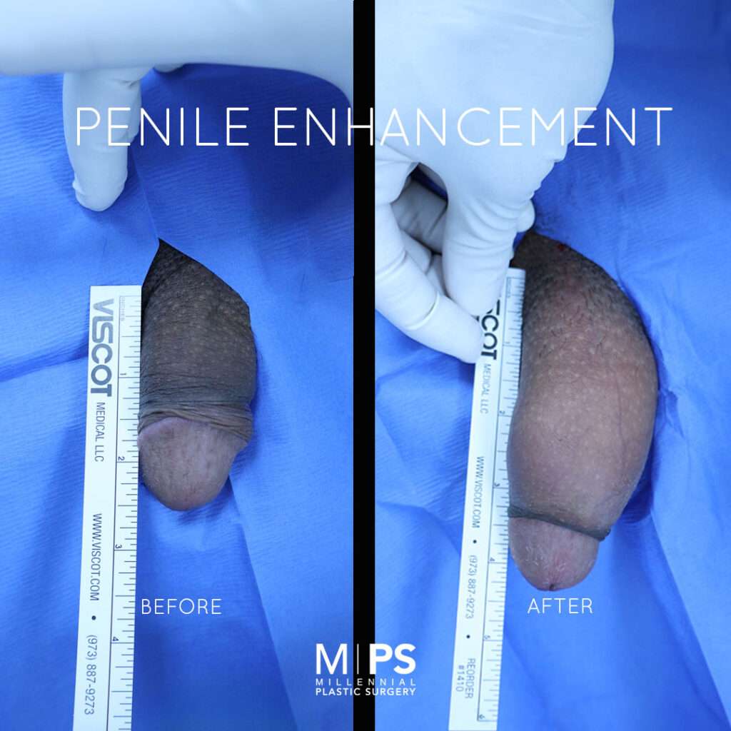 Penile Enhancement Case 2