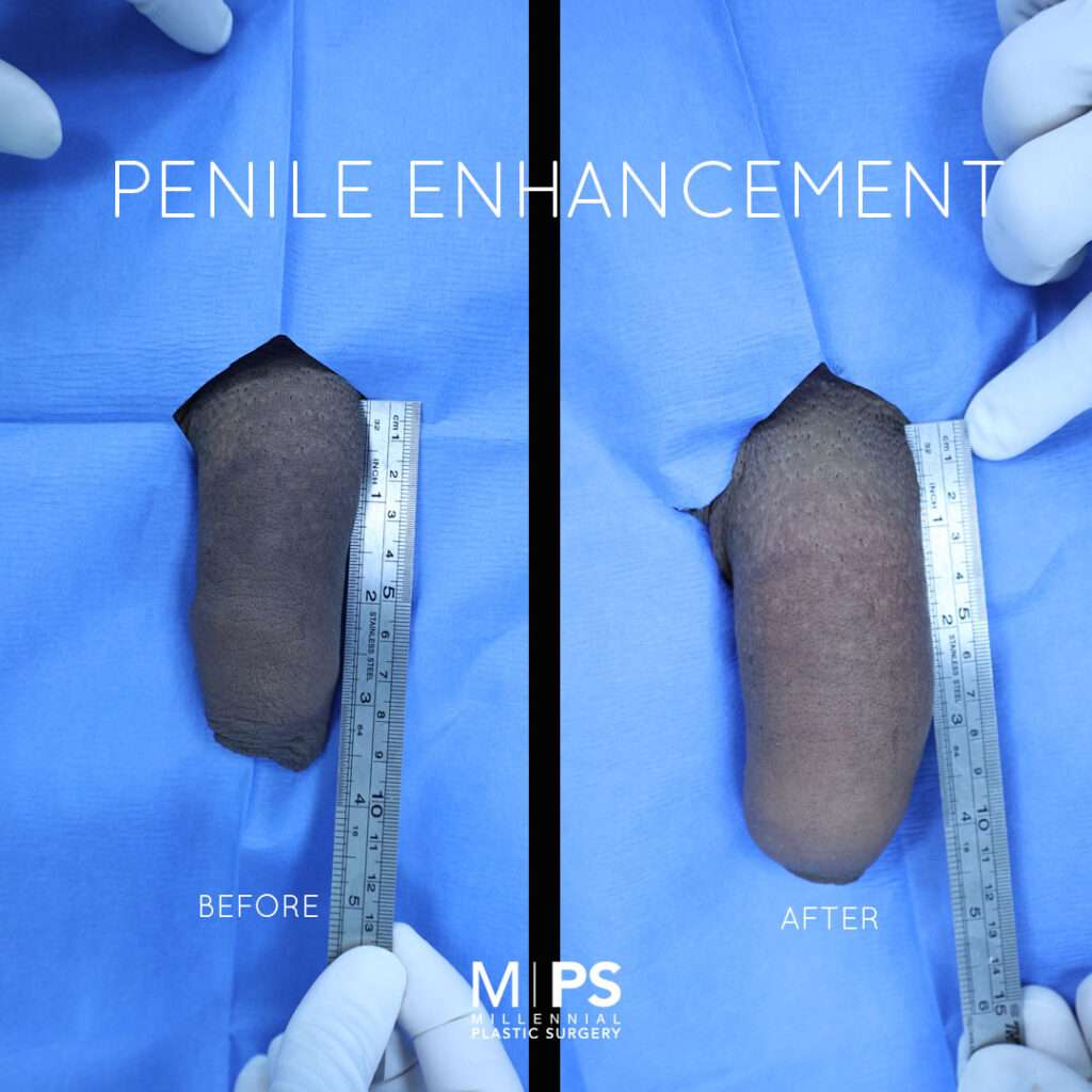 Penile Enhancement Case 3