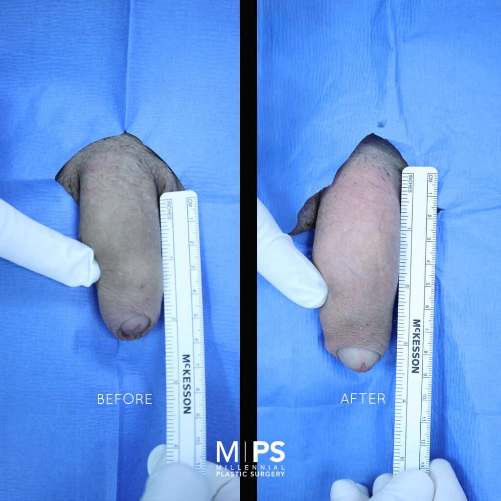 Penile Enhancement Case 4