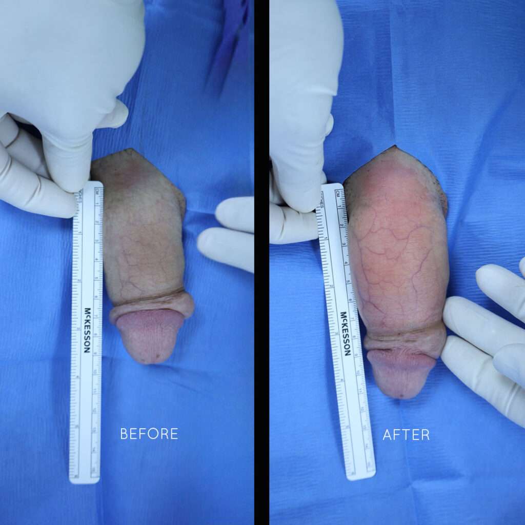 Penile Enhancement Case 5