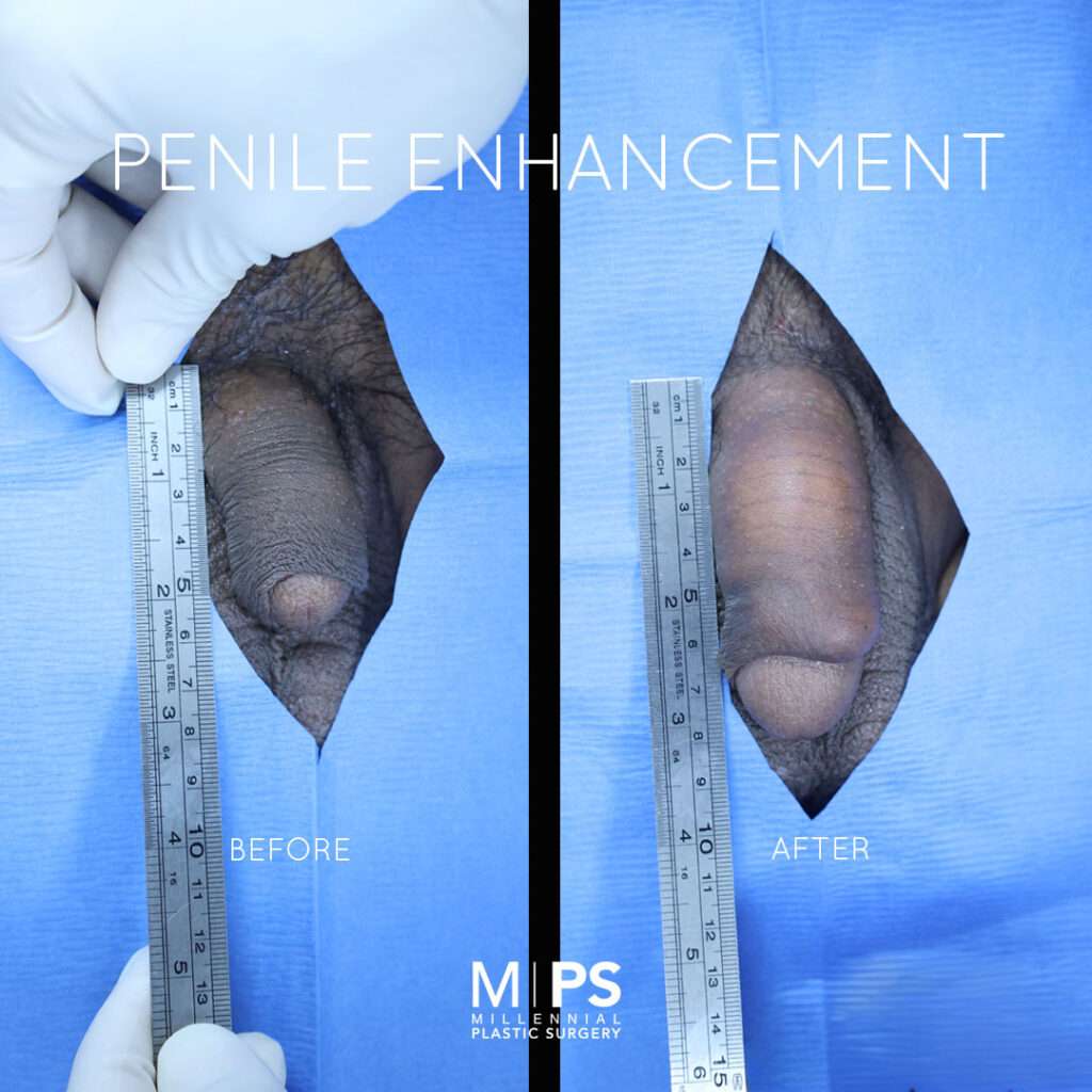 Penile Enhancement Case 6