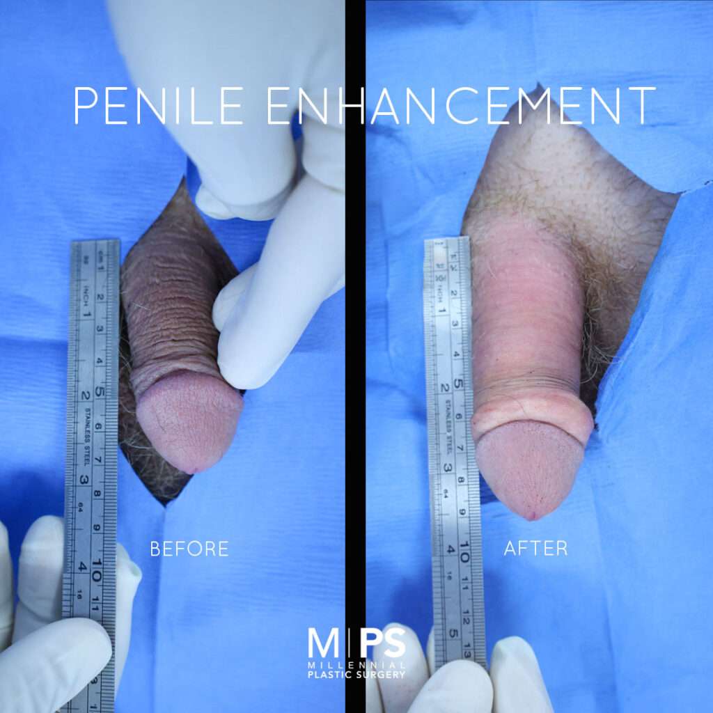 Penile Enhancement Case 7
