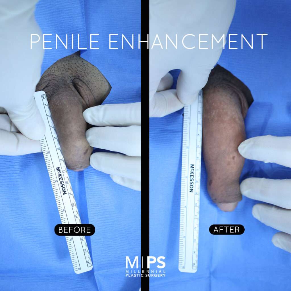Penile Enhancement Case 8