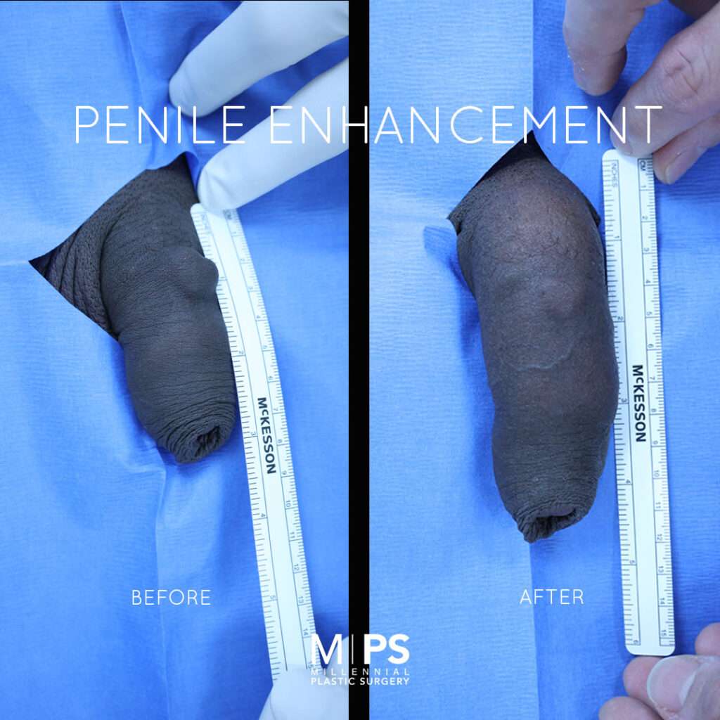 Penile Enhancement Case 9