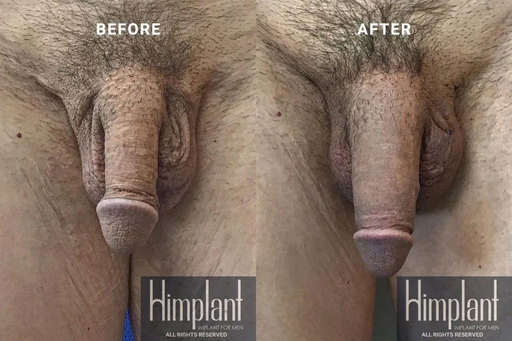 Himplant Penile Enhancement Before and After Case 1