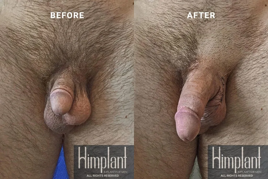 Himplant Penile Enhancement Before and After Case 3