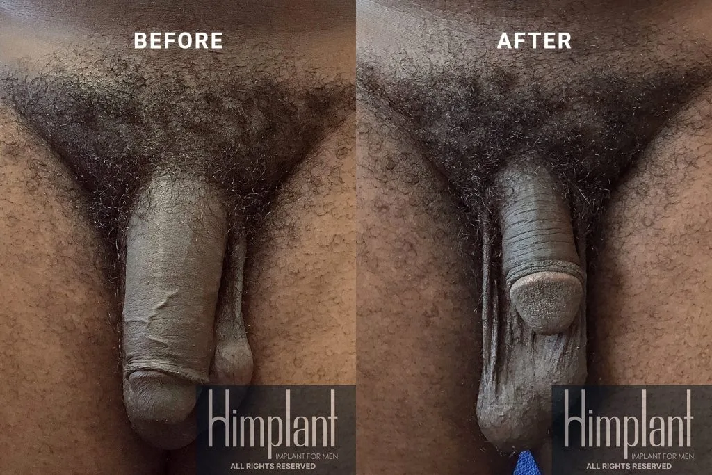 Himplant Penile Enhancement Before and After Case 4