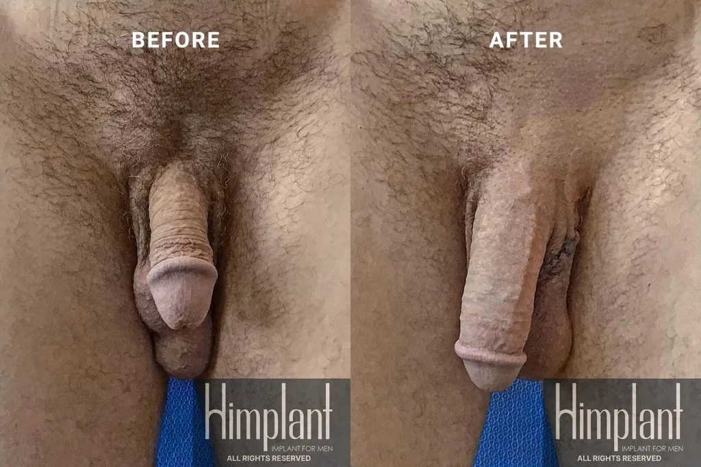 Himplant Penile Enhancement Before and After Case 5