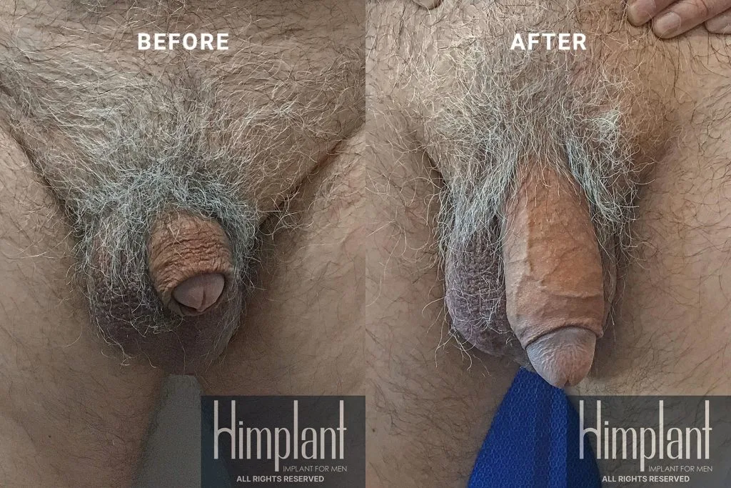 Himplant Penile Enhancement Before and After Case 7