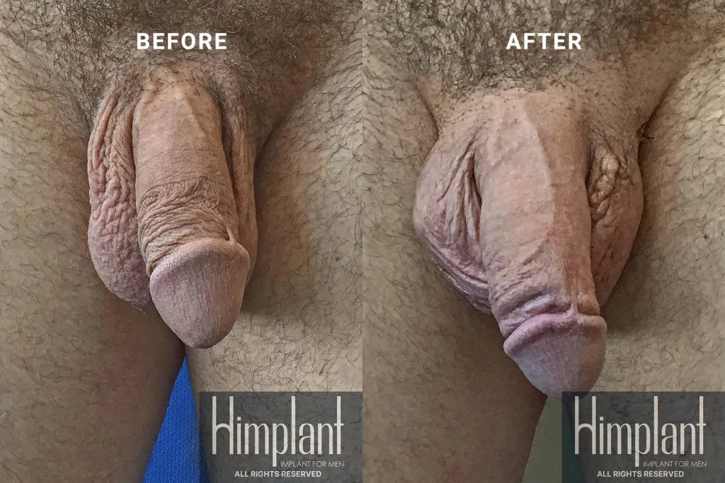Himplant Penile Enhancement Before and After Case 8