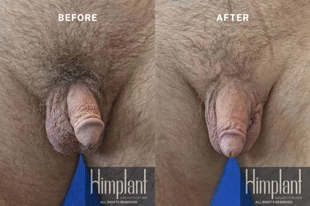 Himplant Penile Enhancement Before and After Case 9