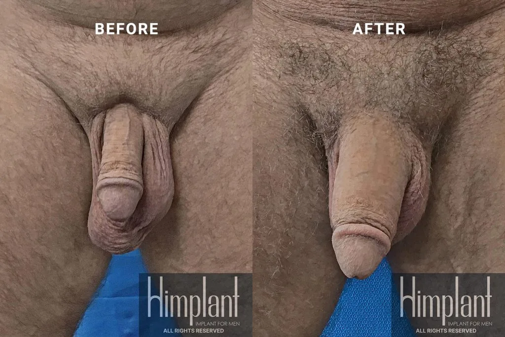 Himplant Penile Enhancement Before and After Case 10