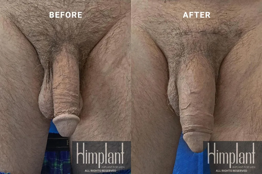 Himplant Penile Enhancement Before and After Case 11
