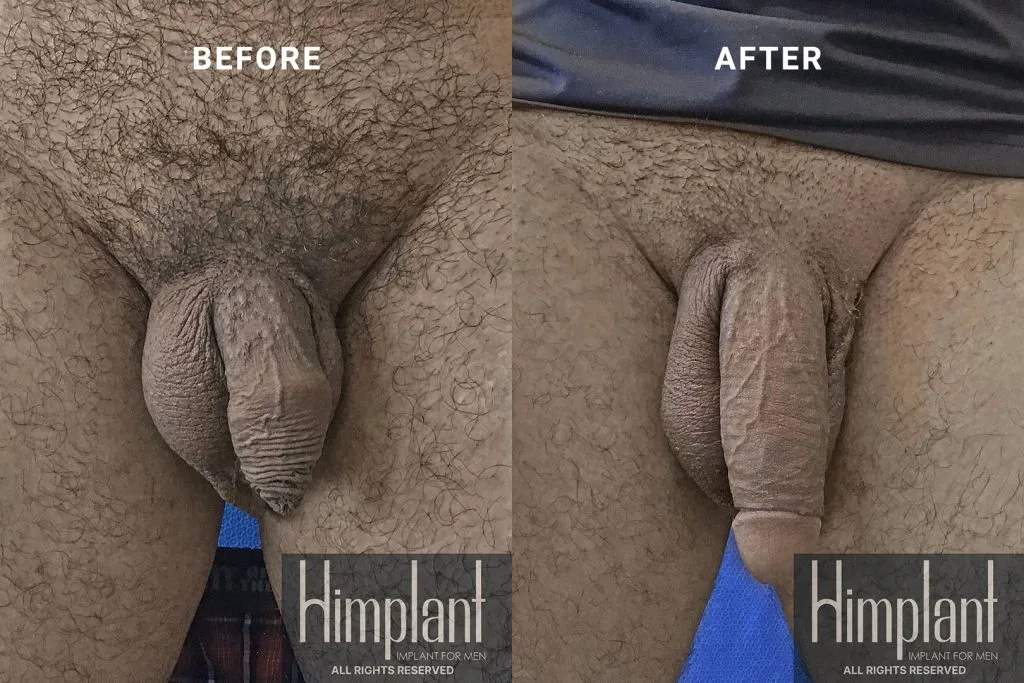 Himplant Penile Enhancement Before and After Case 12