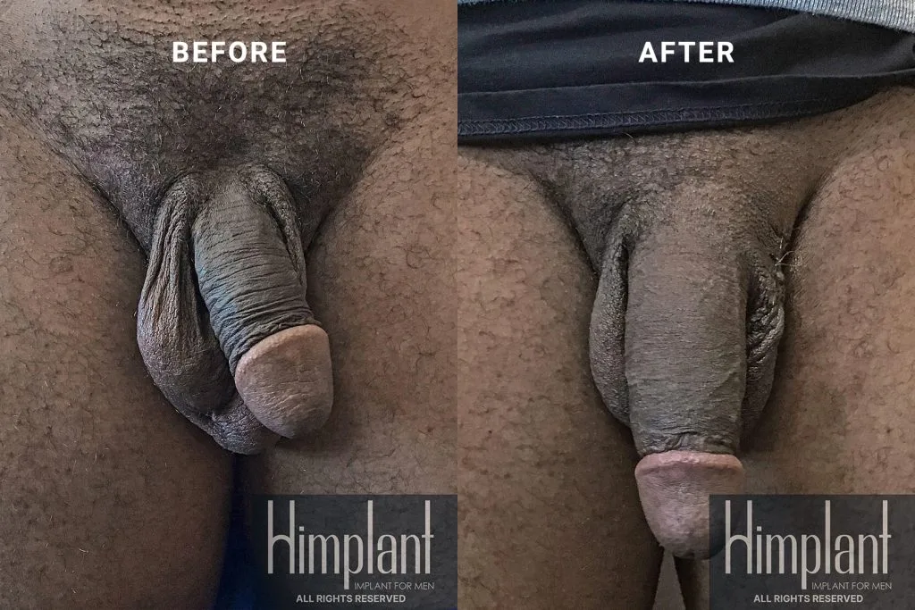 Himplant Penile Enhancement Before and After Case 13