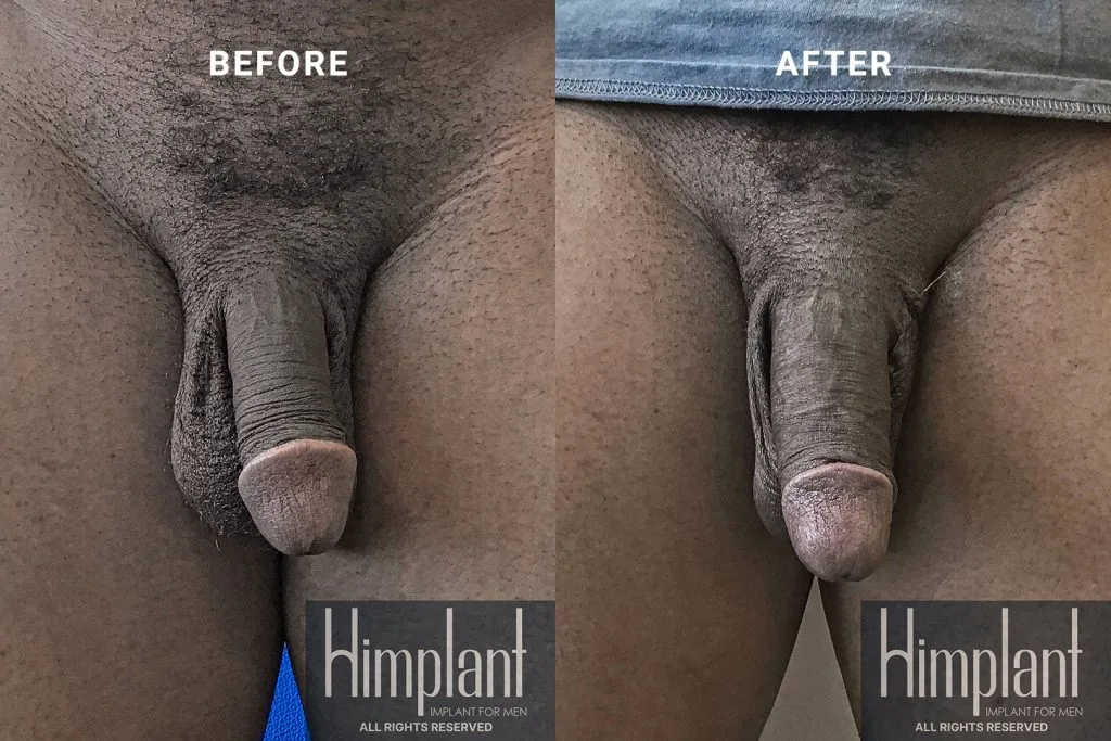 Himplant Penile Enhancement Before and After Case 14