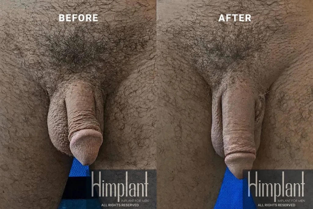 Himplant Penile Enhancement Before and After Case 15