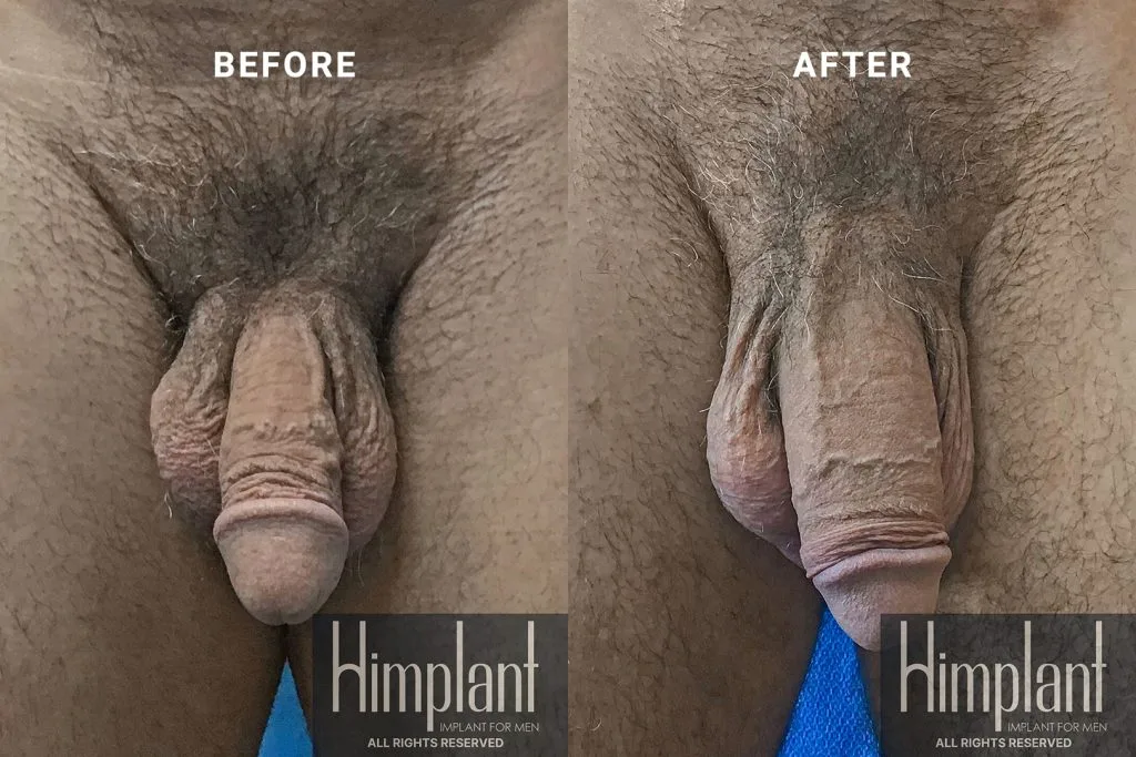 Himplant Penile Enhancement Before and After Case 17