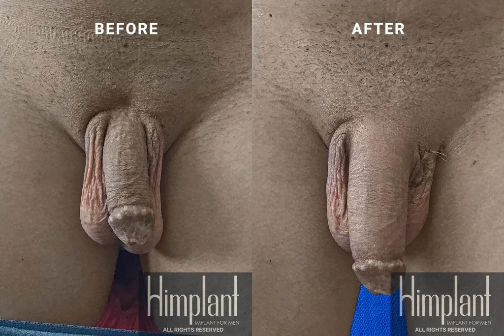 Himplant Penile Enhancement Before and After Case 18