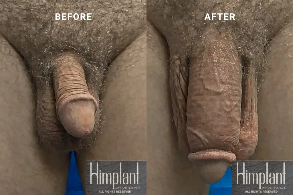 Himplant Penile Enhancement Before and After Case 20