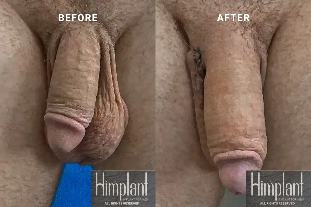 Himplant Penile Enhancement Before and After Case 21