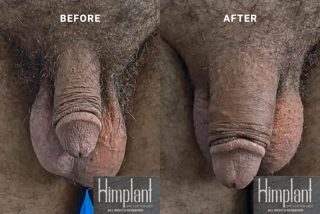 Himplant Penile Enhancement Before and After Case 22