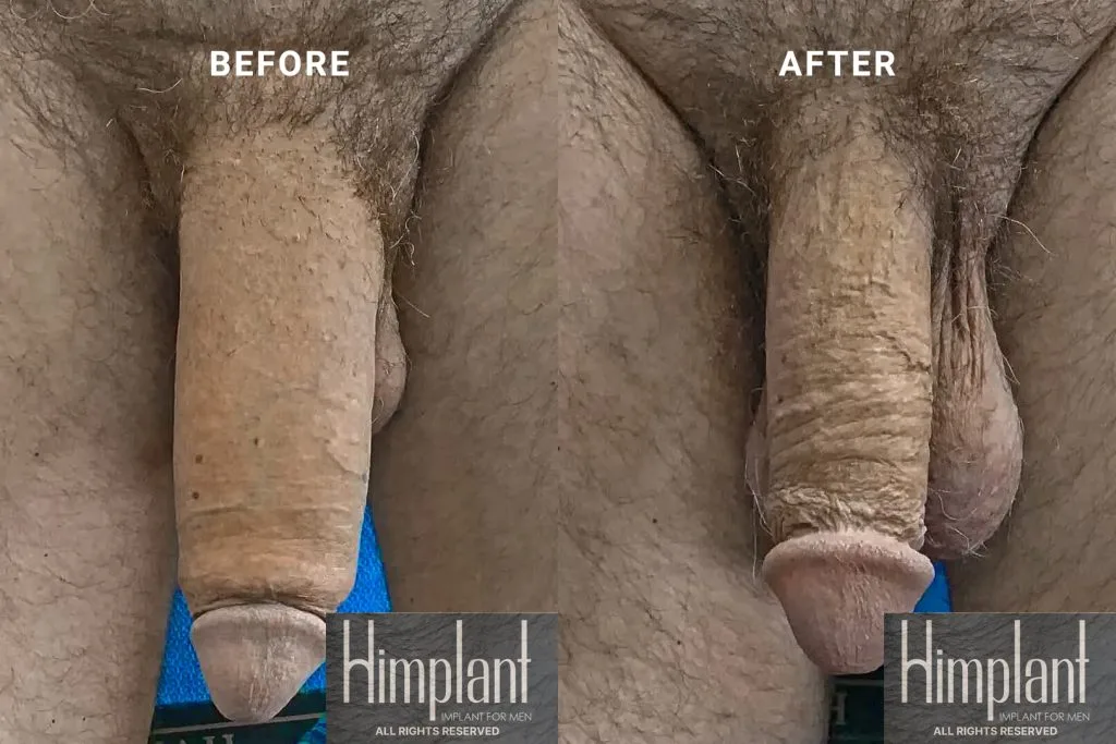 Himplant Penile Enhancement Before and After Case 23