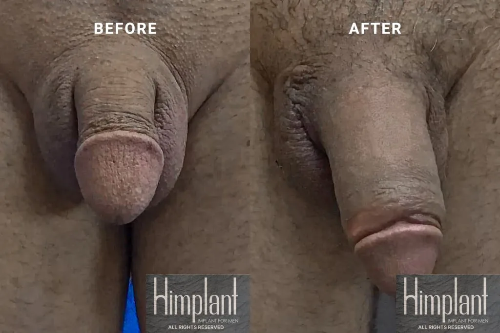 Himplant Penile Enhancement Before and After Case 24