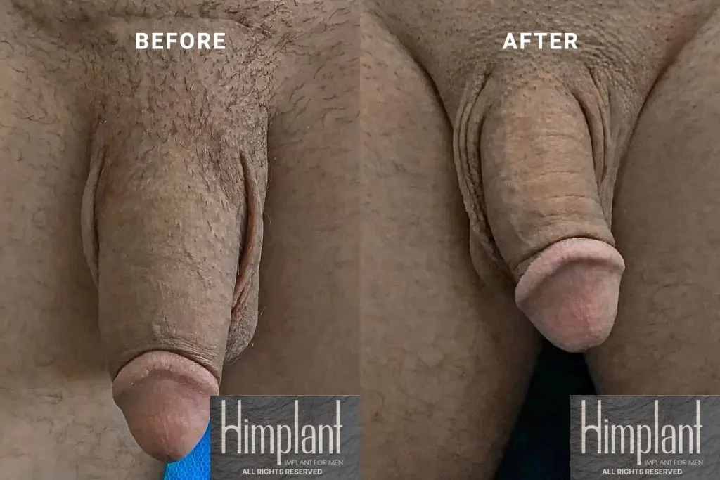 Himplant Penile Enhancement Before and After Case 25