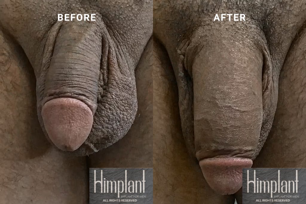 Himplant Penile Enhancement Before and After Case 26