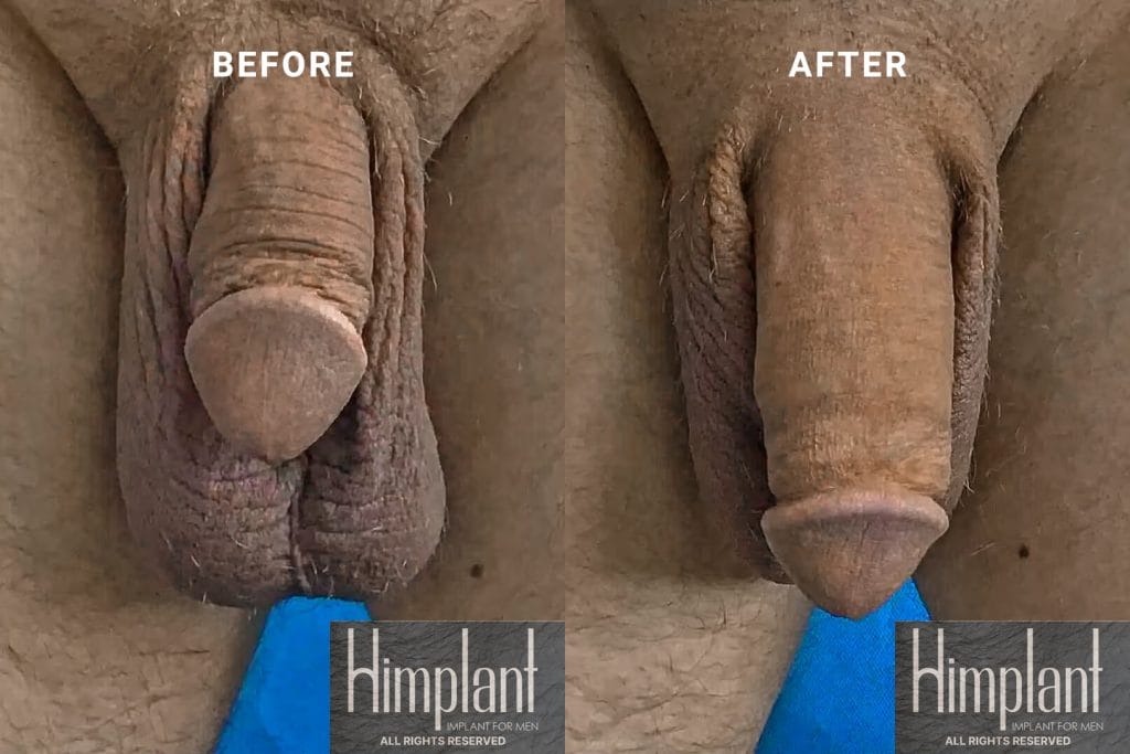 Himplant Penile Enhancement Before and After Case 27