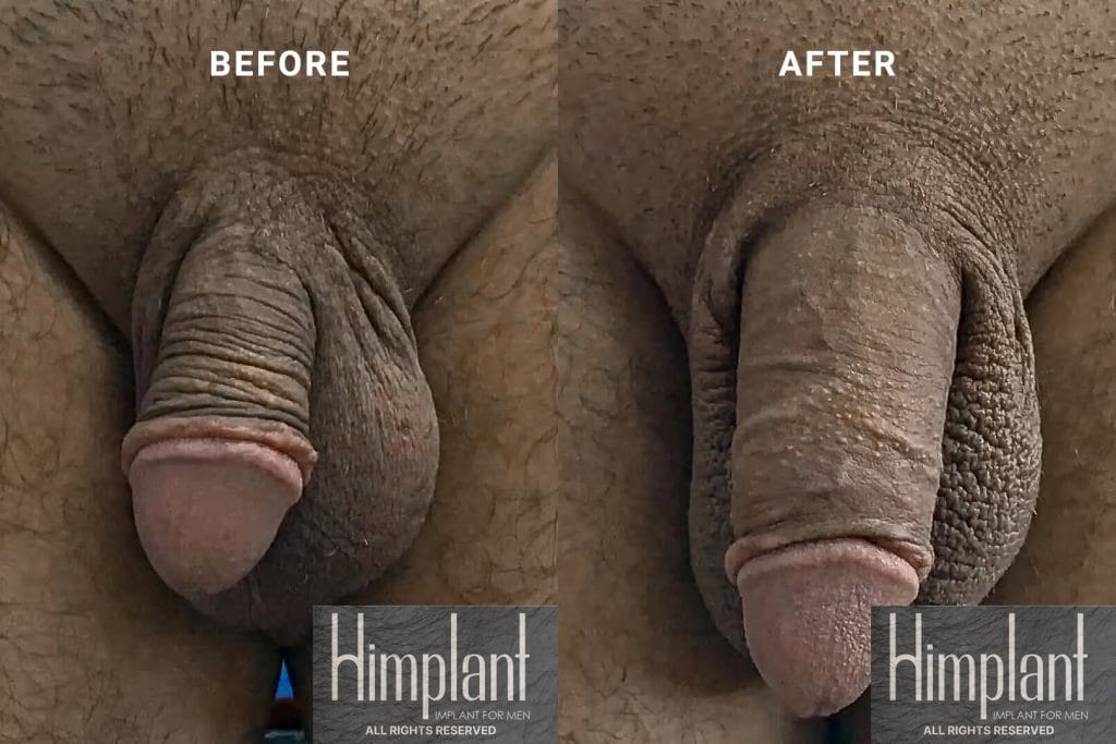 Himplant Penile Enhancement Before and After Case 28