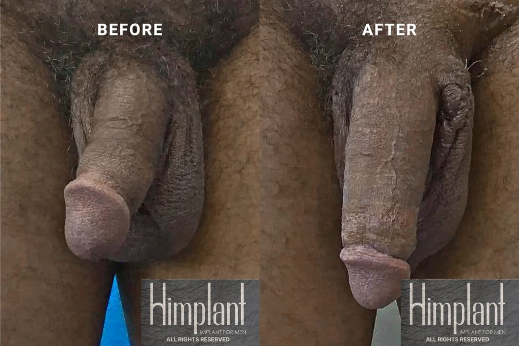 Himplant Penile Enhancement Before and After Case 29