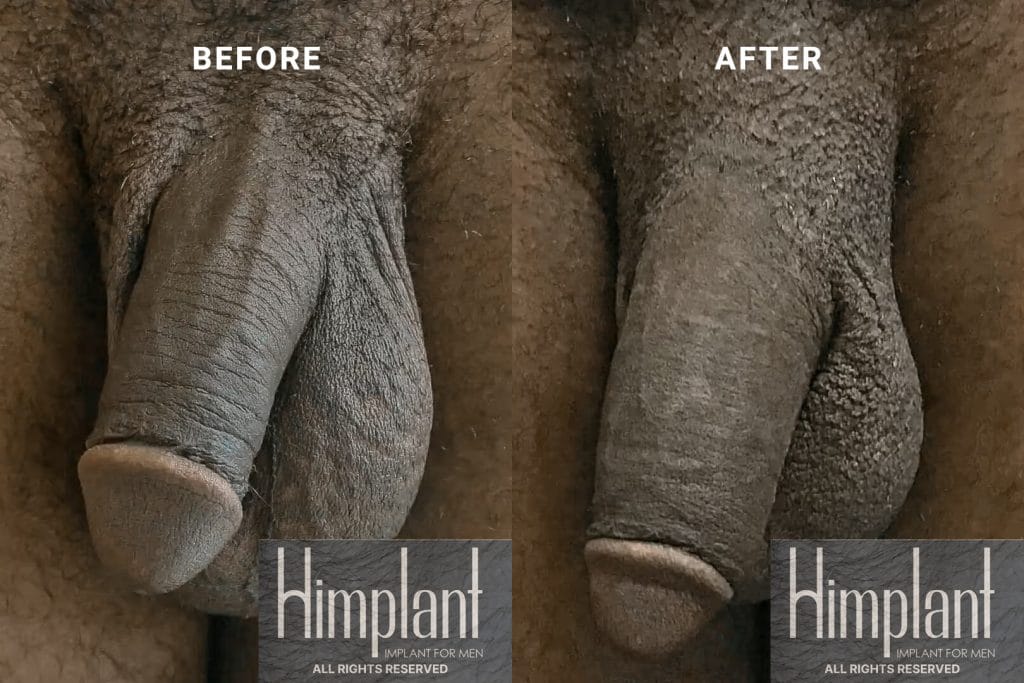 Himplant Penile Enhancement Before and After Case 30