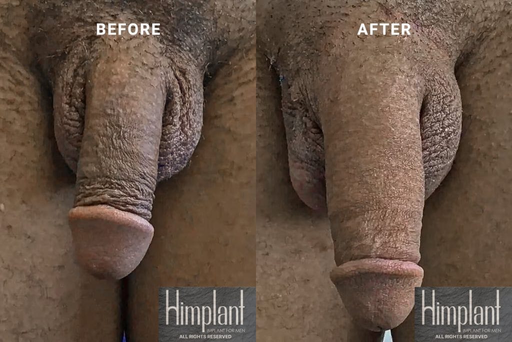 Himplant Penile Enhancement Before and After Case 31