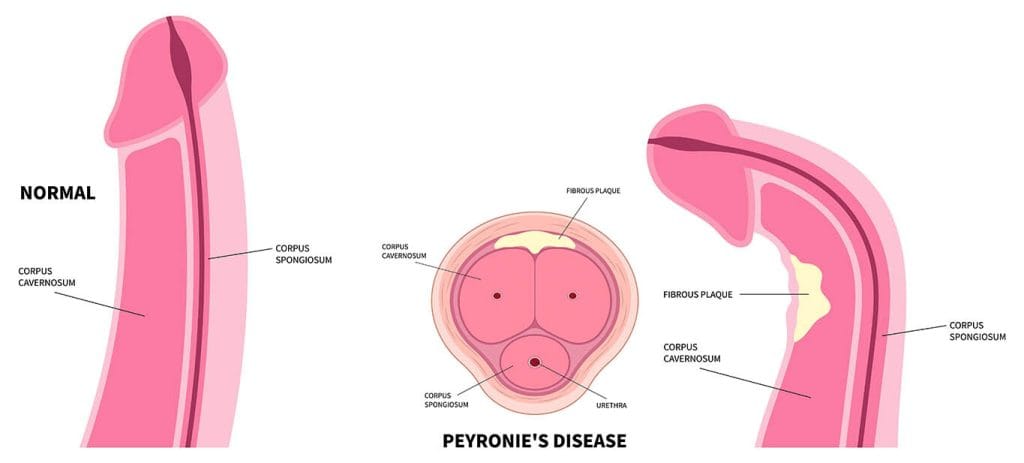 Peyronie’s disease scar tissue causing penile curvature and asymmetry