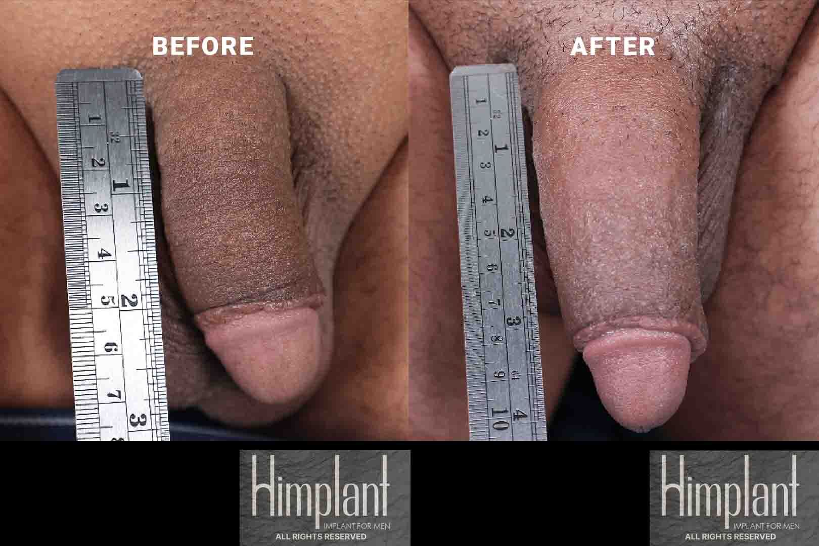 Himplant Penile Enhancement Case-26